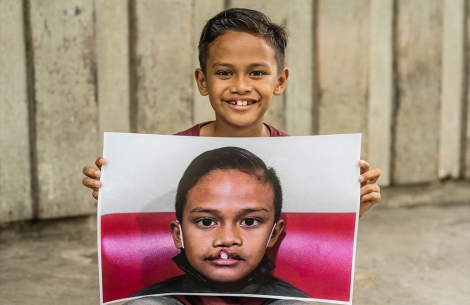 Zafran smiling and holding a picture of himself before cleft surgery