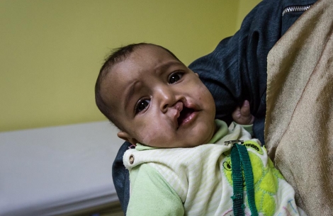 Rawda in her mother's arms before cleft surgery