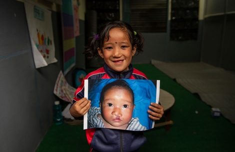Sushila holds the image of herself before cleft surgery