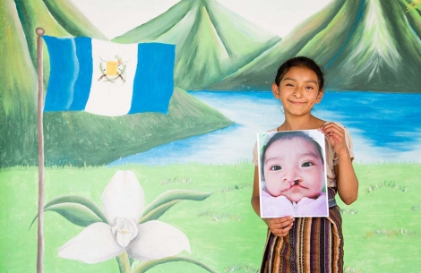 Valery holds the image of herself before cleft lip surgery