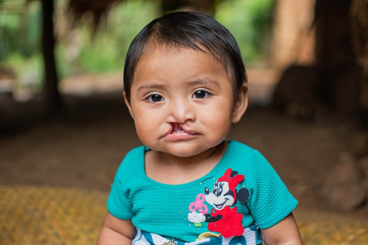 A girl with an cleft lip looks at camera