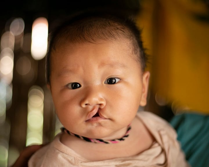 A child with cleft from Laos