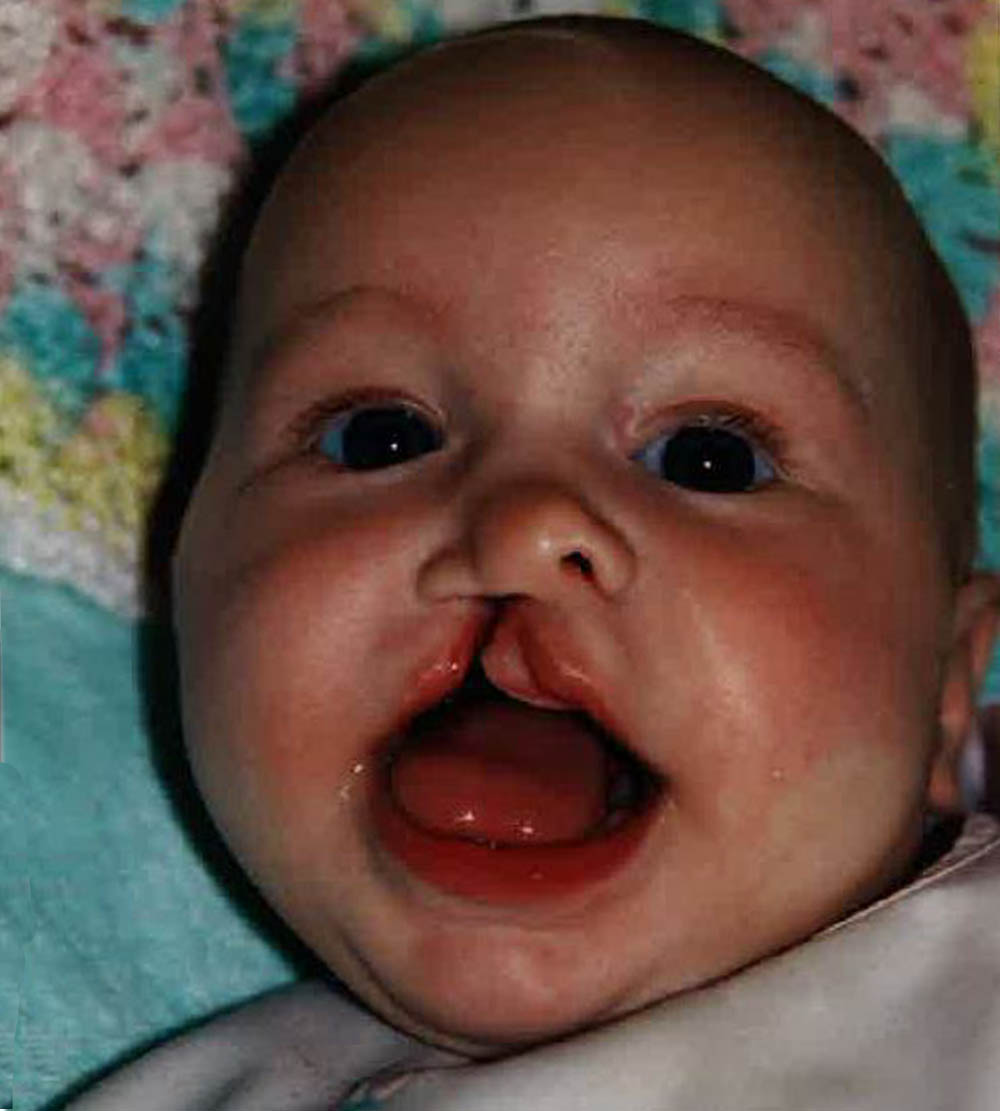 Grace Peters before cleft surgery