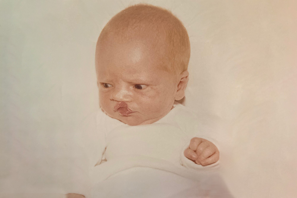 Jim Rowe as a newborn with a cleft