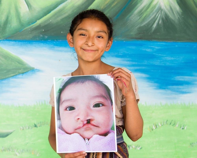 Valery holds the image of herself before cleft lip surgery