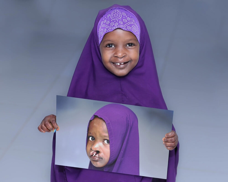 child holds the image of herself before cleft lip surgery